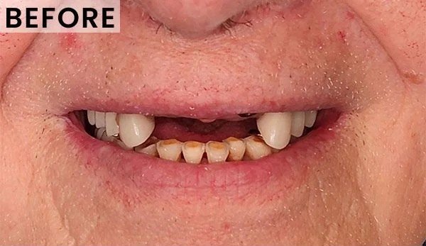 Before — multiple missing teeth restored with implants at Presidio Dental