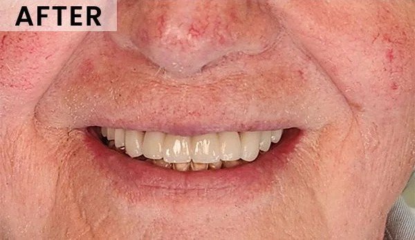 After — implant-supported bridge with stable, natural smile